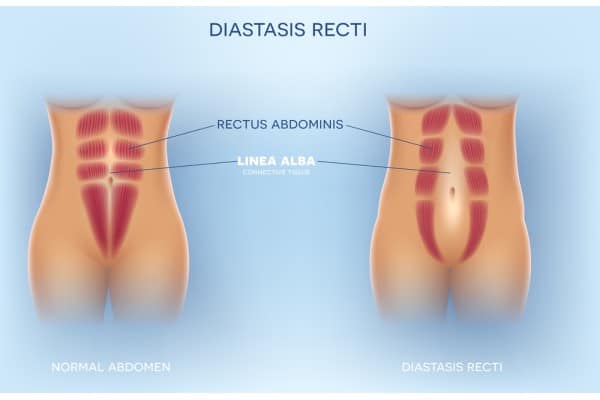 What Non-Surgical Options Are Available for Diastasis Recti Stoke upon Trent?