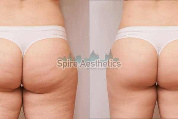 before and after cryolipolysis