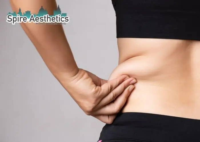 Image of woman pinching fat on their hips Stoke upon Trent. Fat Freezing treatment