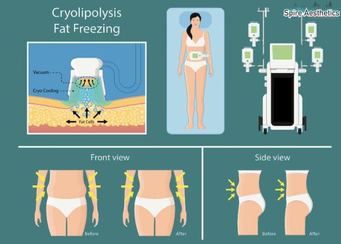 Image of diet and fat freezing combined for best results for Spire Aesthetics Stoke upon Trent