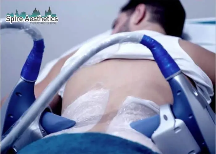 Man having fat freezing treatment done on love handles before a competitions Stoke upon Trent to create a sculpted look.
