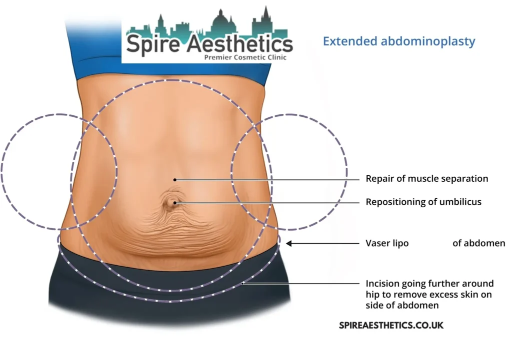 Understanding Loose Skin After Gastric Band Stoke upon Trent Surgery and HIFU Treatment