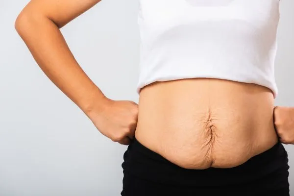 Image of a woman's stomach after weight loss with sagging skin following a gastric band Stoke upon Trent
