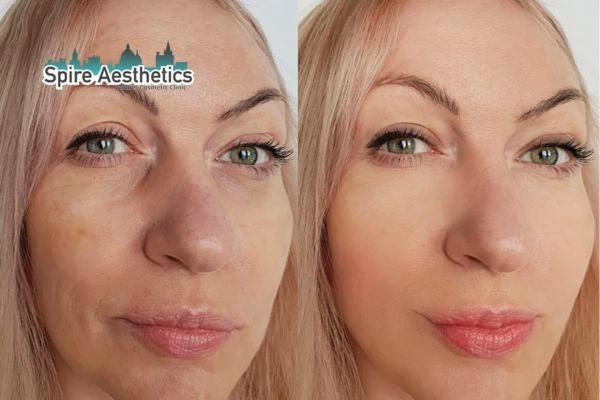 Morpheus8 Treatment Stoke upon Trent Before & After Results