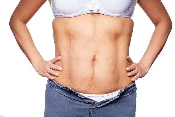 sagging skin on woman's stomach after weight loss injections Stoke upon Trent