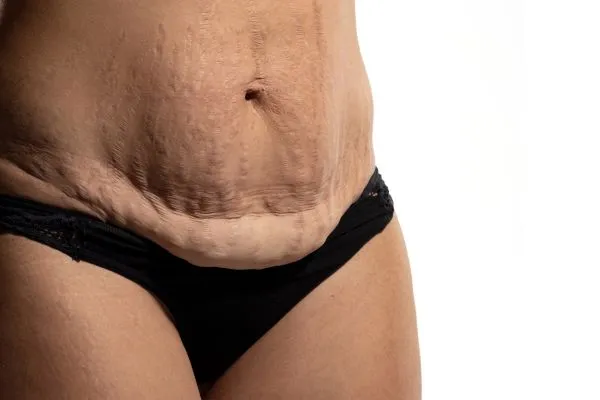 Image of womans stomach after weight loss injections Stoke upon Trent showing saggy skin
