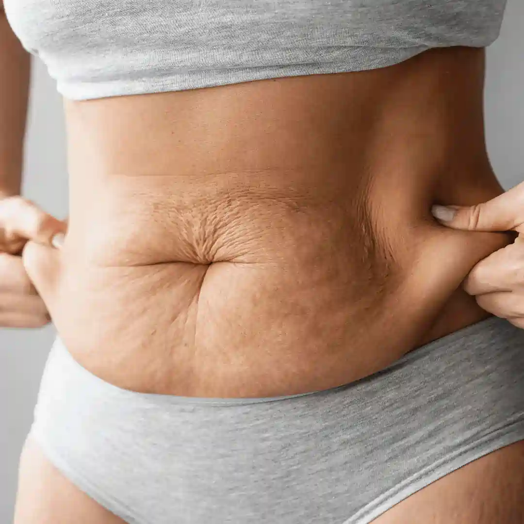 Is It Normal to Have Loose Skin After Pregnancy Stoke upon Trent?