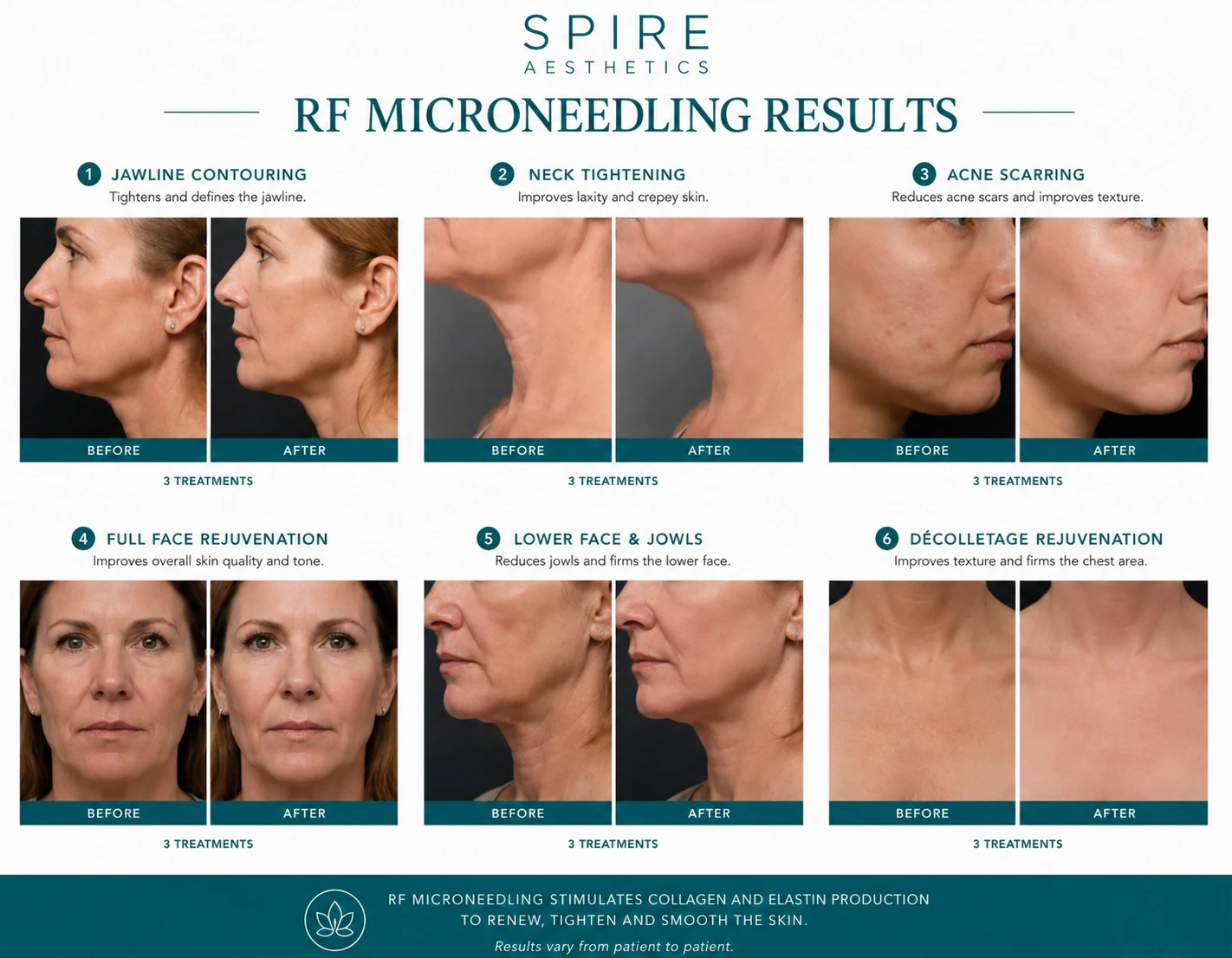 RF Microneedling Skin tightening Stoke upon Trent results