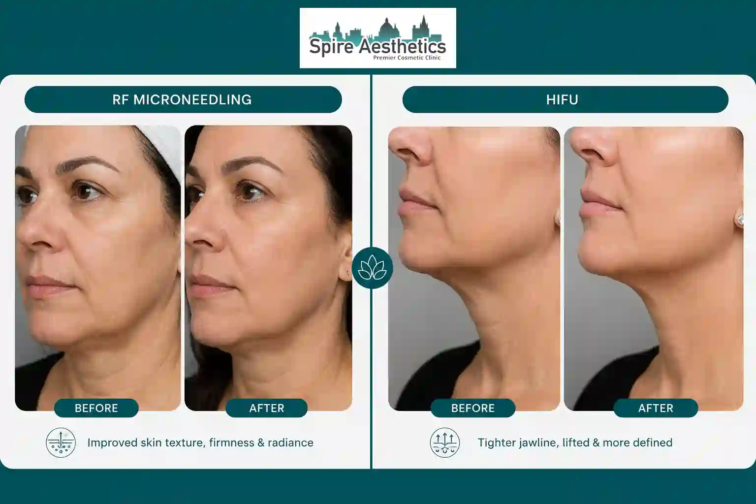 Can RF Microneedling and HIFU Be Combined Stoke upon Trent?