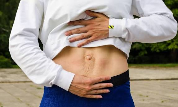 When Could Diastasis Recti Be the Missing Piece of the Puzzle Stoke upon Trent?